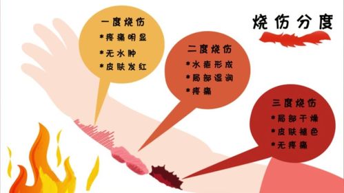 如何处理被烧伤