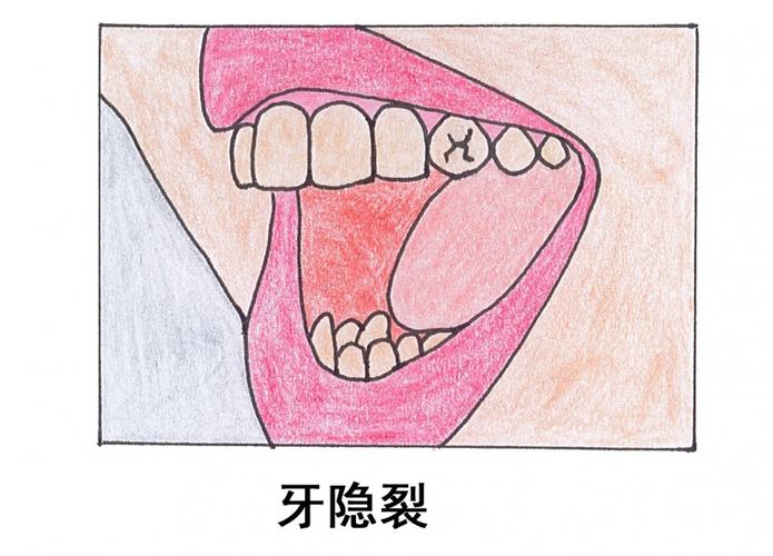 如何避免牙齿断裂