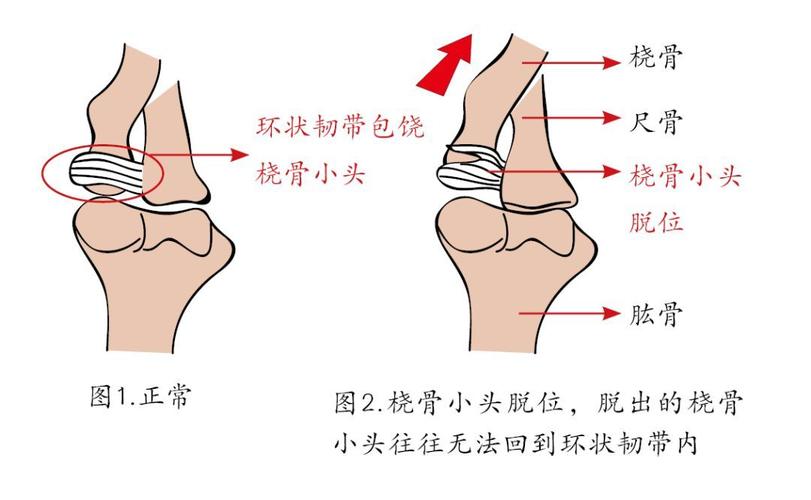 如何防止脱臼