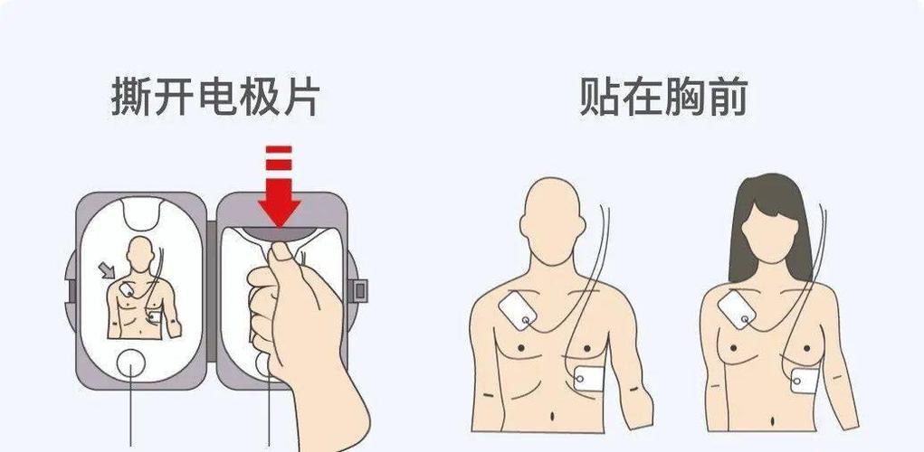 如何正确使用AED