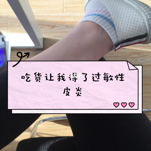 如何快速止过敏