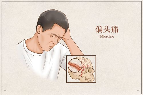 怎样防止头痛