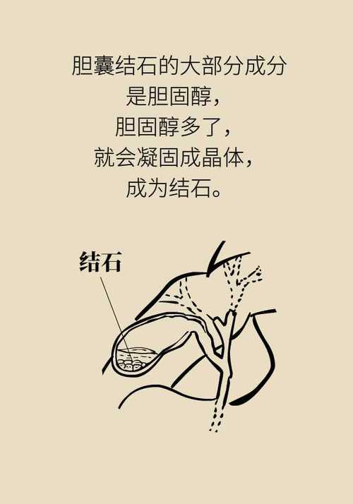 如何避免胆结石