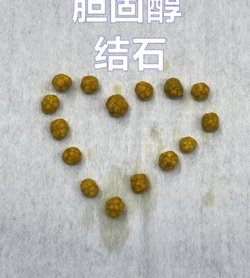 如何防止胆结石
