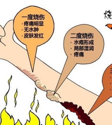 怎样防止烧伤